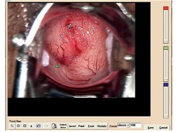 [29621] COLPOSCOPY SOFTWARE for 29620, 29600 with 29603