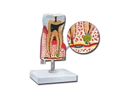 [40214] LOWER MOLAR WITH CARIES - 10X